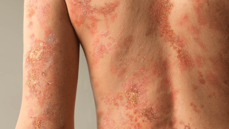 Generalized pustular psoriasis