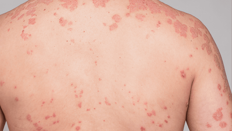 Generalized pustular psoriasis vs plaque psoriasis: plaque psoriasis flare images